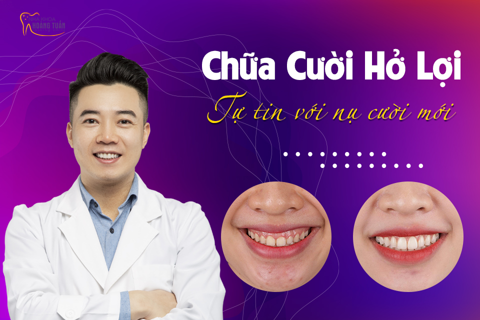 cách chữa cười hở lợi