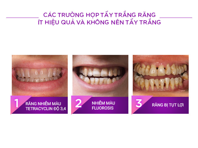 Các trường hợp tẩy trắng răng ít hiệu quả và không nên tẩy trắng