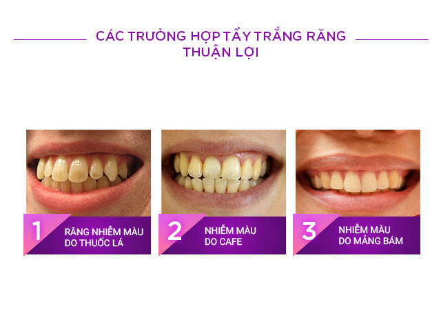 Các trường hợp tẩy trắng răng thuận lợi 