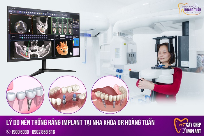 Trồng răng implant mất bao lâu