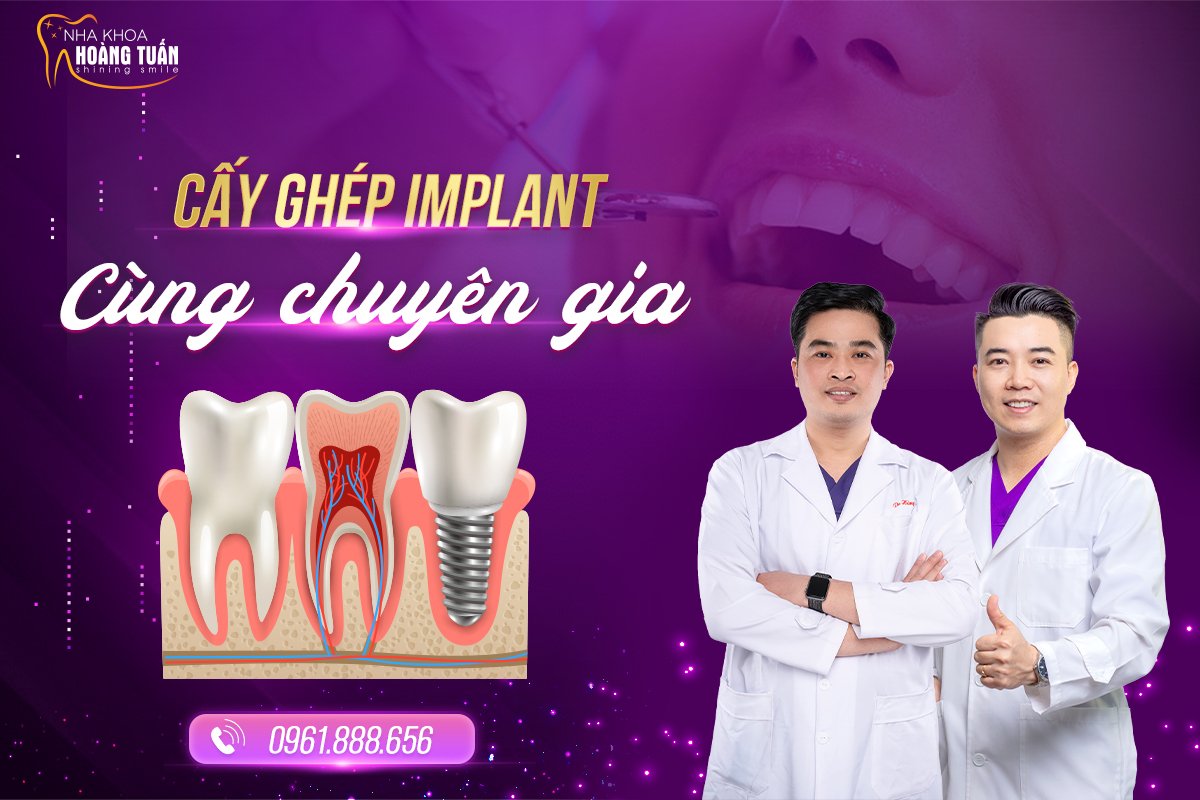 Cấy ghép implant có tốt không