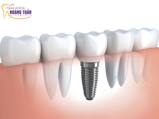 cấy ghép implant có an toàn không