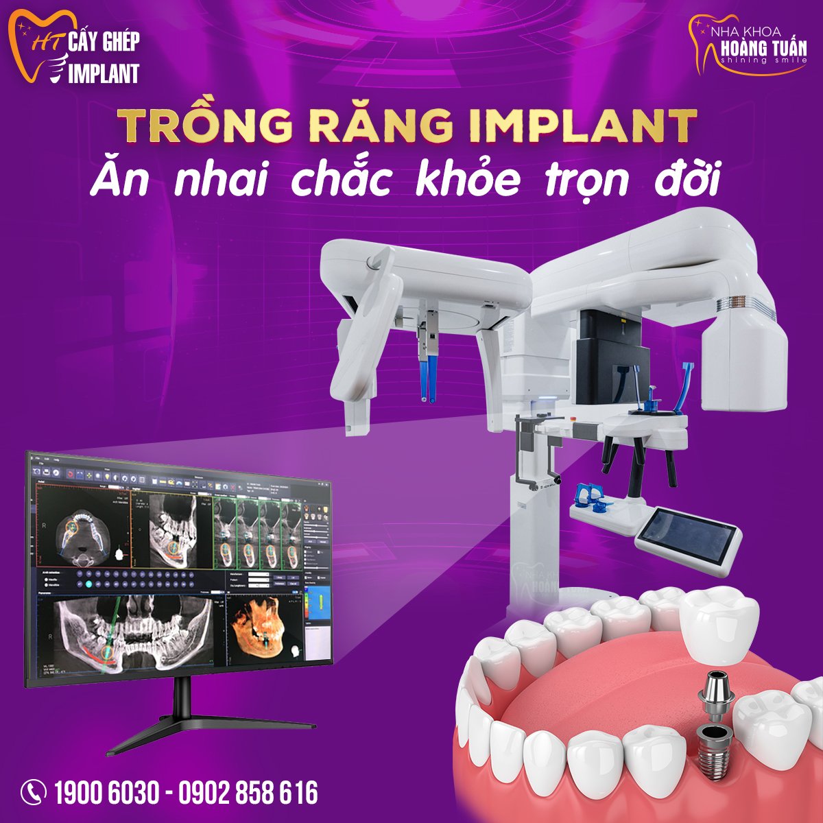 có nên cấy ghép implant