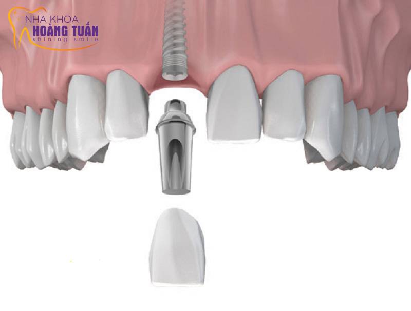 Cấy ghép implant răng cửa