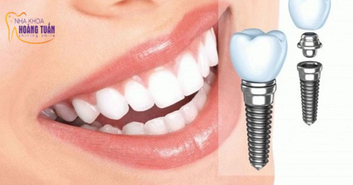 Cấy ghép implant răng cửa