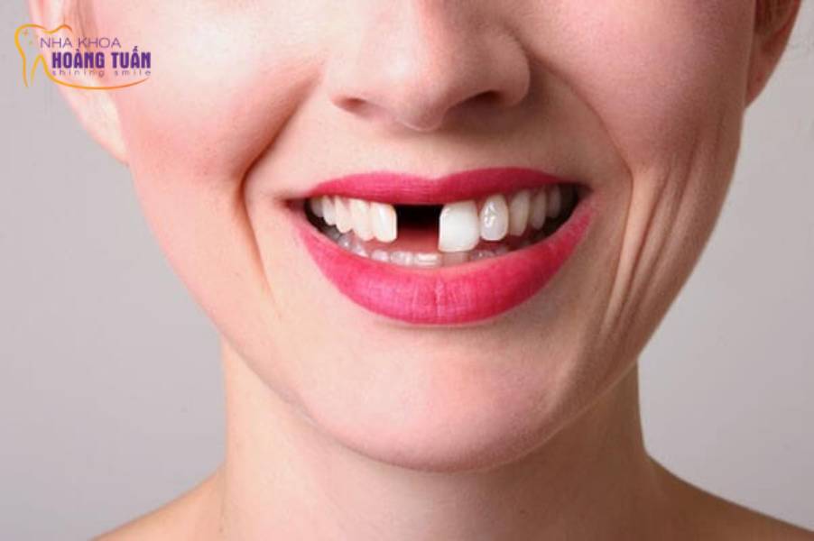 Cấy ghép implant răng cửa