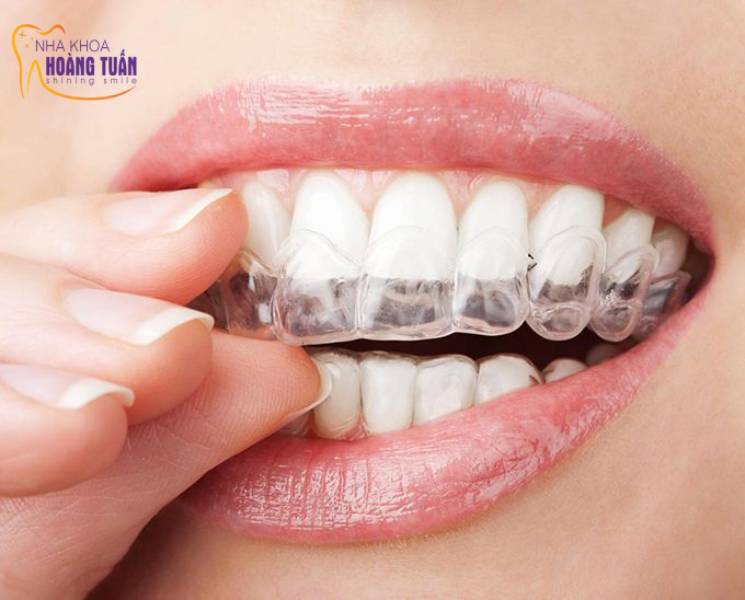 có nên niềng răng Invisalign