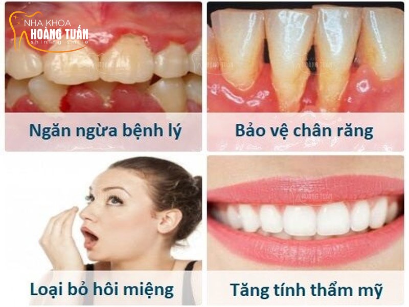 Lấy cao răng