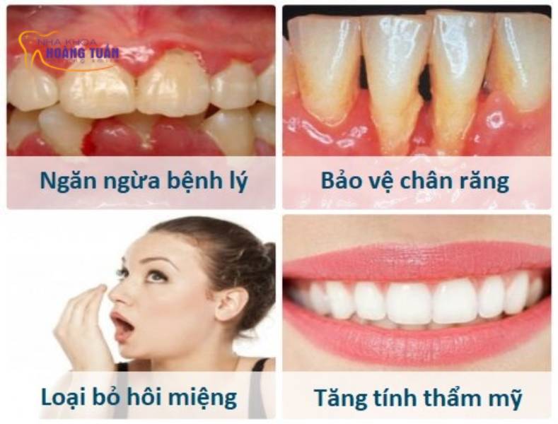 lấy cao răng bao nhiêu tiền