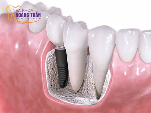 cấy ghép implant mất thời gian bao lâu