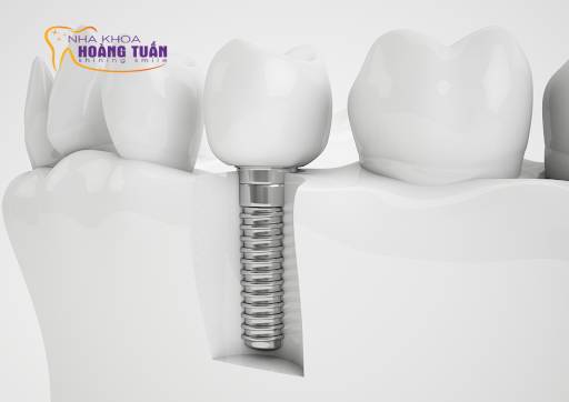 có nên cấy ghép implant