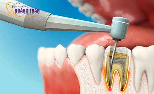 điều trị tủy răng như thế nào