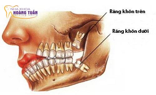 Nhổ răng khôn hàm trên