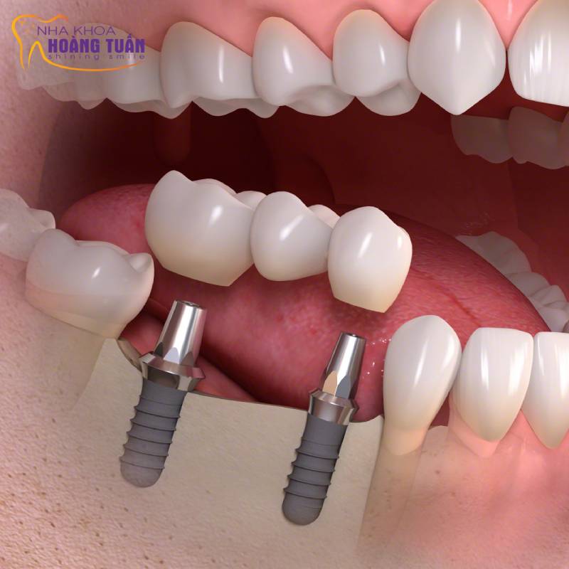 trồng răng Implant Hàn Quốc 