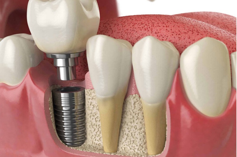 kinh nghiệm đi trồng răng implant