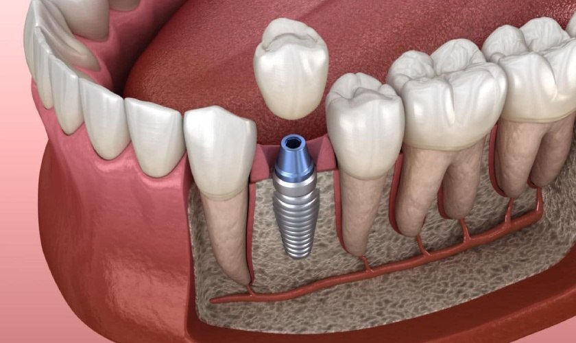 kinh nghiệm đi trồng răng implant