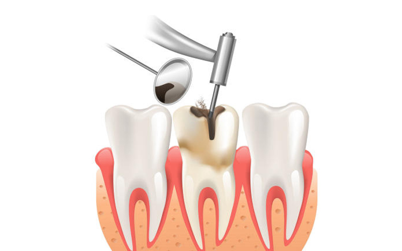 lấy tuỷ răng có tiêm thuốc tê không