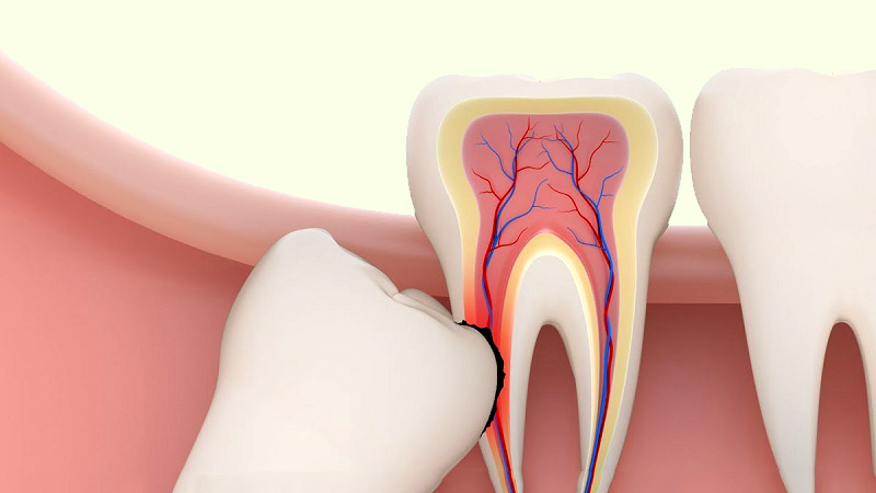 nhổ răng khôn có mọc lại không