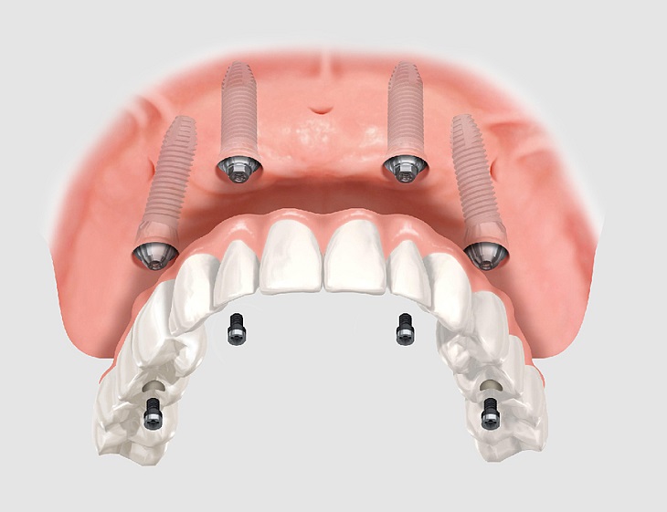 trồng răng implant bao lâu thì lành