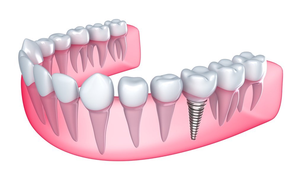 cấy ghép implant sau khi nhổ răng