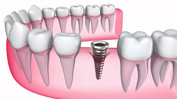 cấy ghép implant sau khi nhổ răng