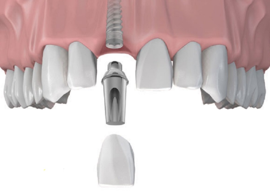 Cấy ghép implant tức thì