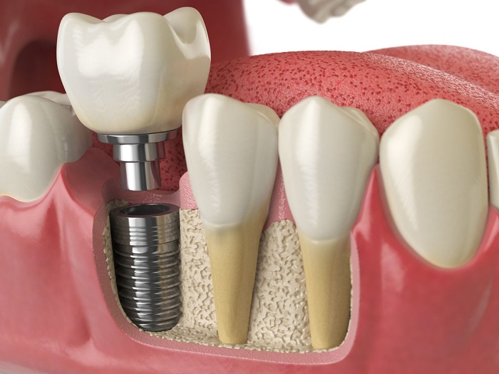 Cấy ghép implant tức thì