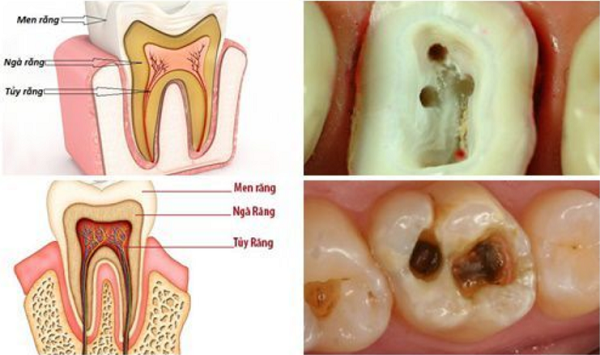 điều trị tuỷ răng số 6