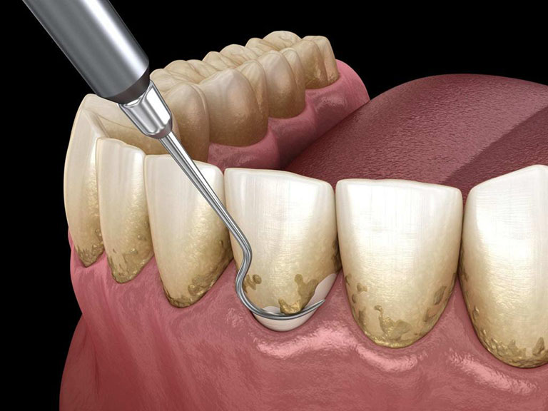 lấy cao răng có đắt không