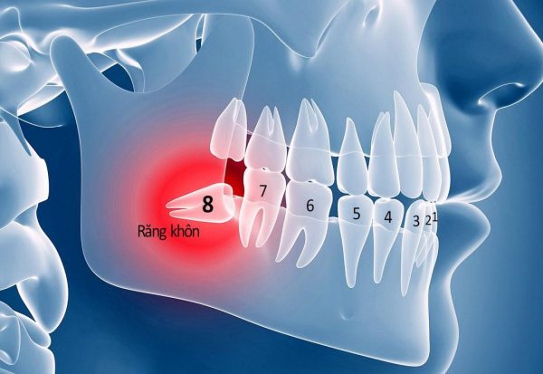 nhổ răng khôn 1 lần mấy cái