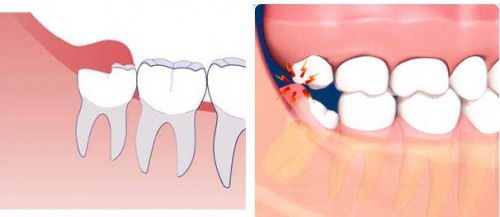 sau nhổ răng khôn đau mấy ngày