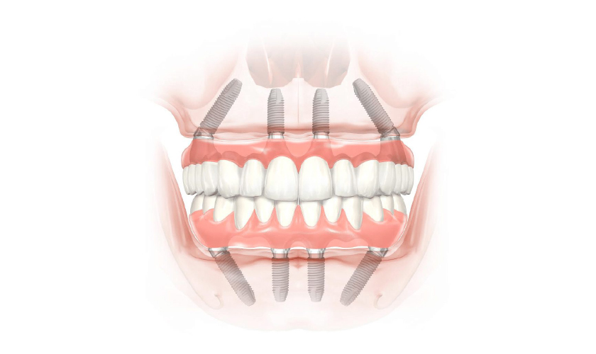 Trồng răng Implant All-on-4