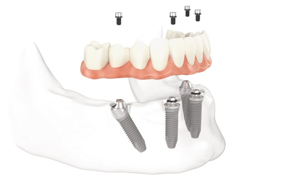 Trồng răng Implant All-on-4