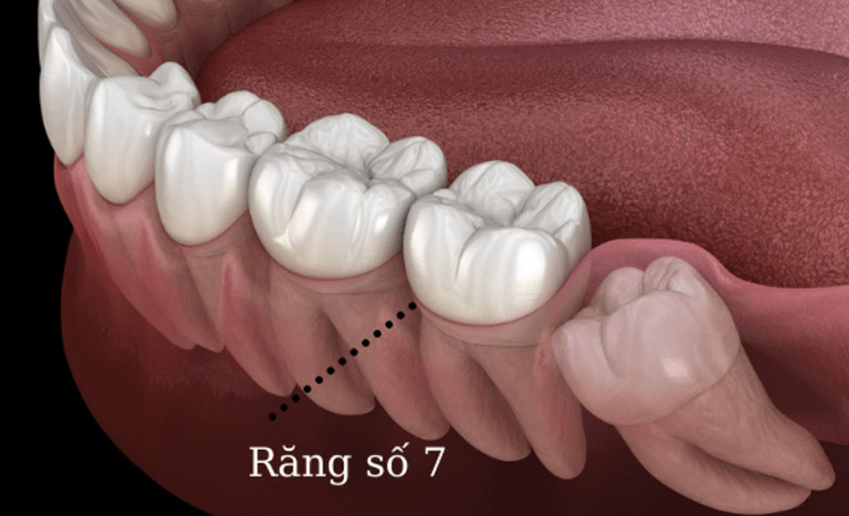 Điều trị tuỷ răng số 7