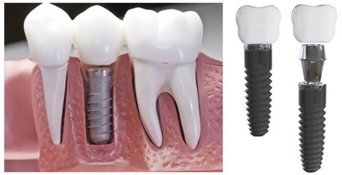 giá trồng răng implant hàn quốc