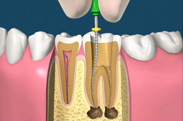 lấy tủy răng lần 2 có đau không