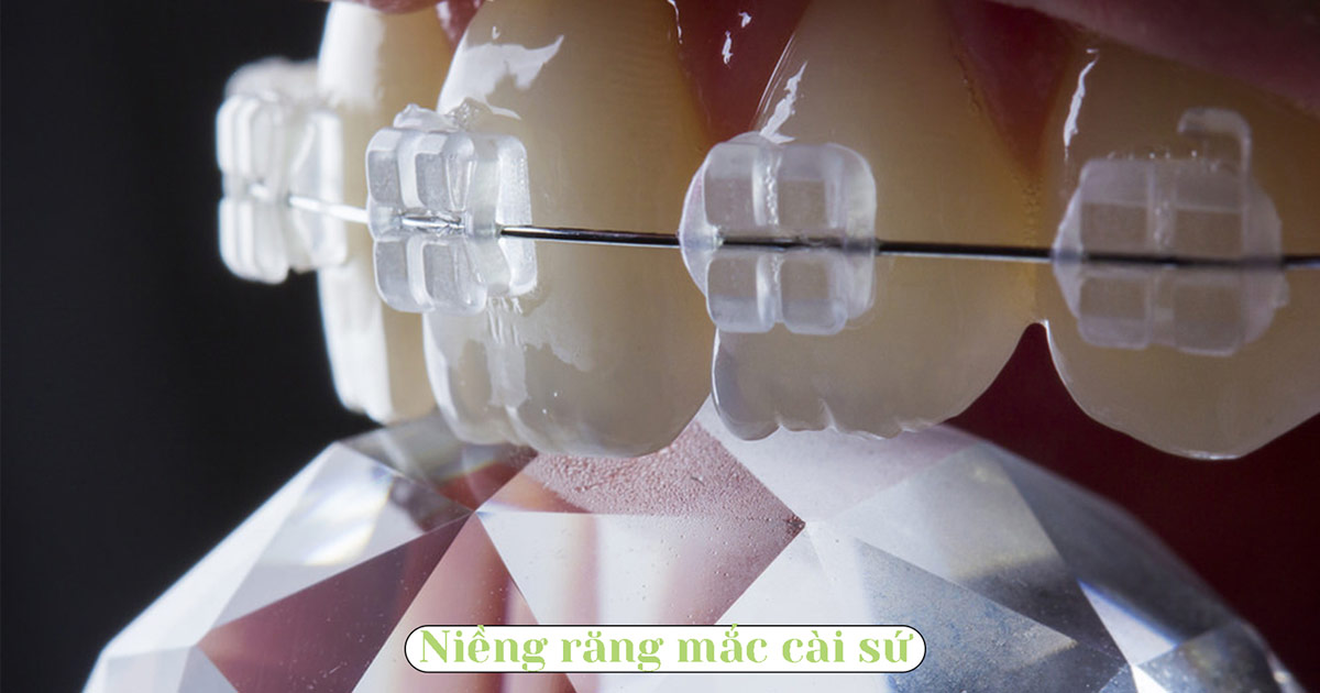 niềng răng mắc cài nào tốt