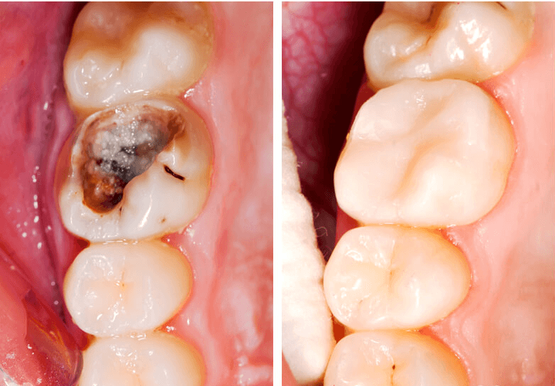 trám răng rồi có niềng được không