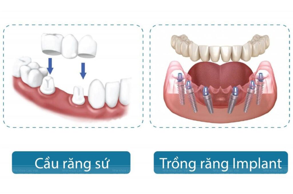 trồng răng implant và cầu răng sứ