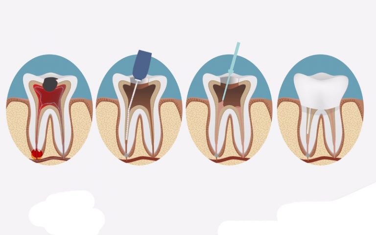 Lấy tủy răng như thế nào?