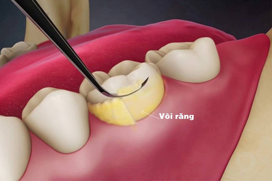 lấy vôi răng có bị mòn răng không