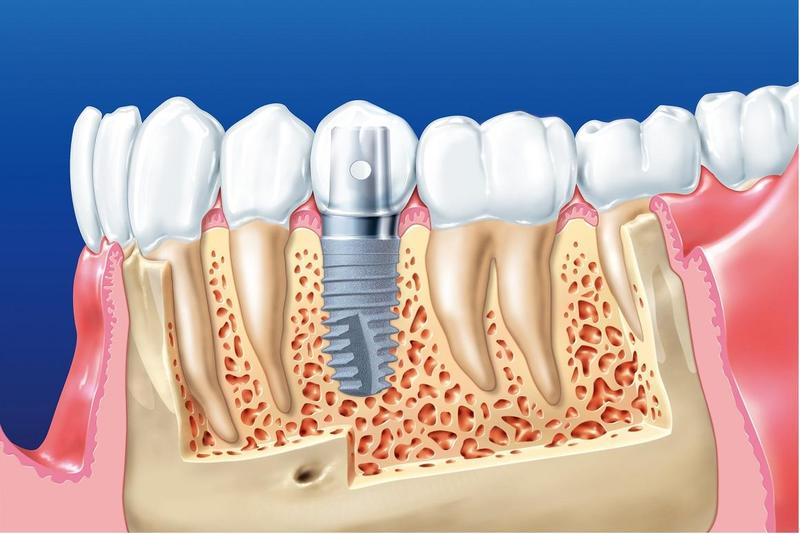 Trồng răng implant cả hàm