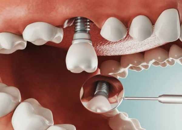 ưu điểm của cấy ghép implant