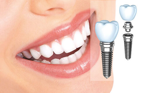 ưu điểm của cấy ghép implant