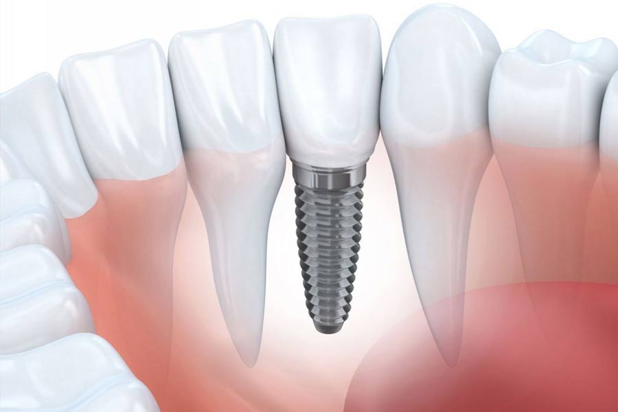 ưu điểm của cấy ghép implant