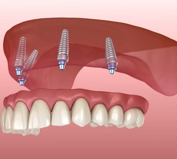 cấy ghép implant cho người mất nhiều răng