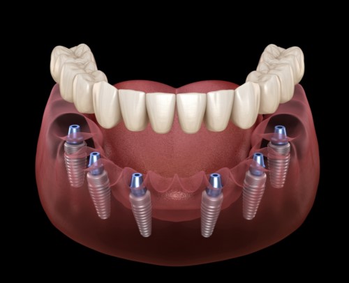 cấy ghép implant cho người mất nhiều răng