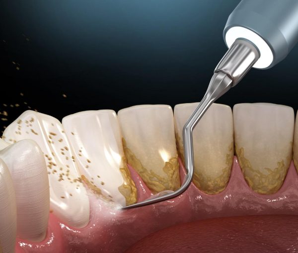 lấy cao răng mấy tháng một lần lấy cao răng mấy tháng một lần