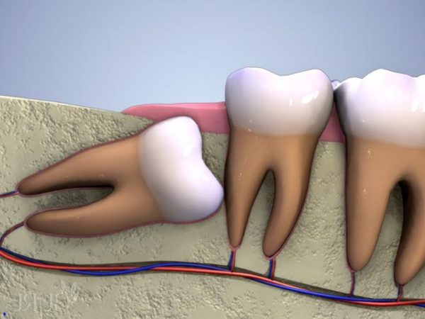 nhổ răng khôn hàm dưới có nguy hiểm không