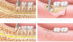 nhổ răng khôn hàm dưới có nguy hiểm không